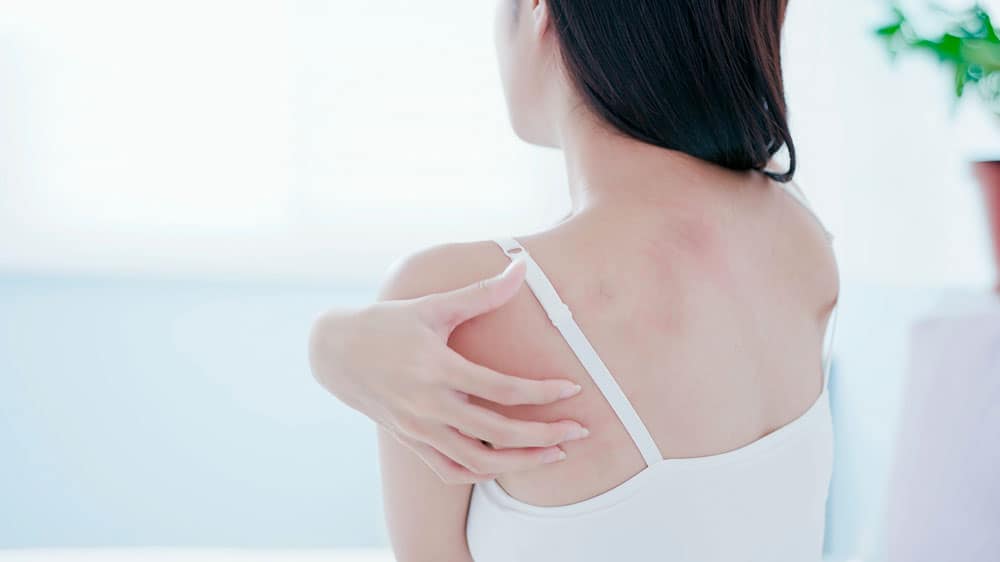 Punture di insetti reazione allergia istamina Punture di insetti reazione allergia istamina